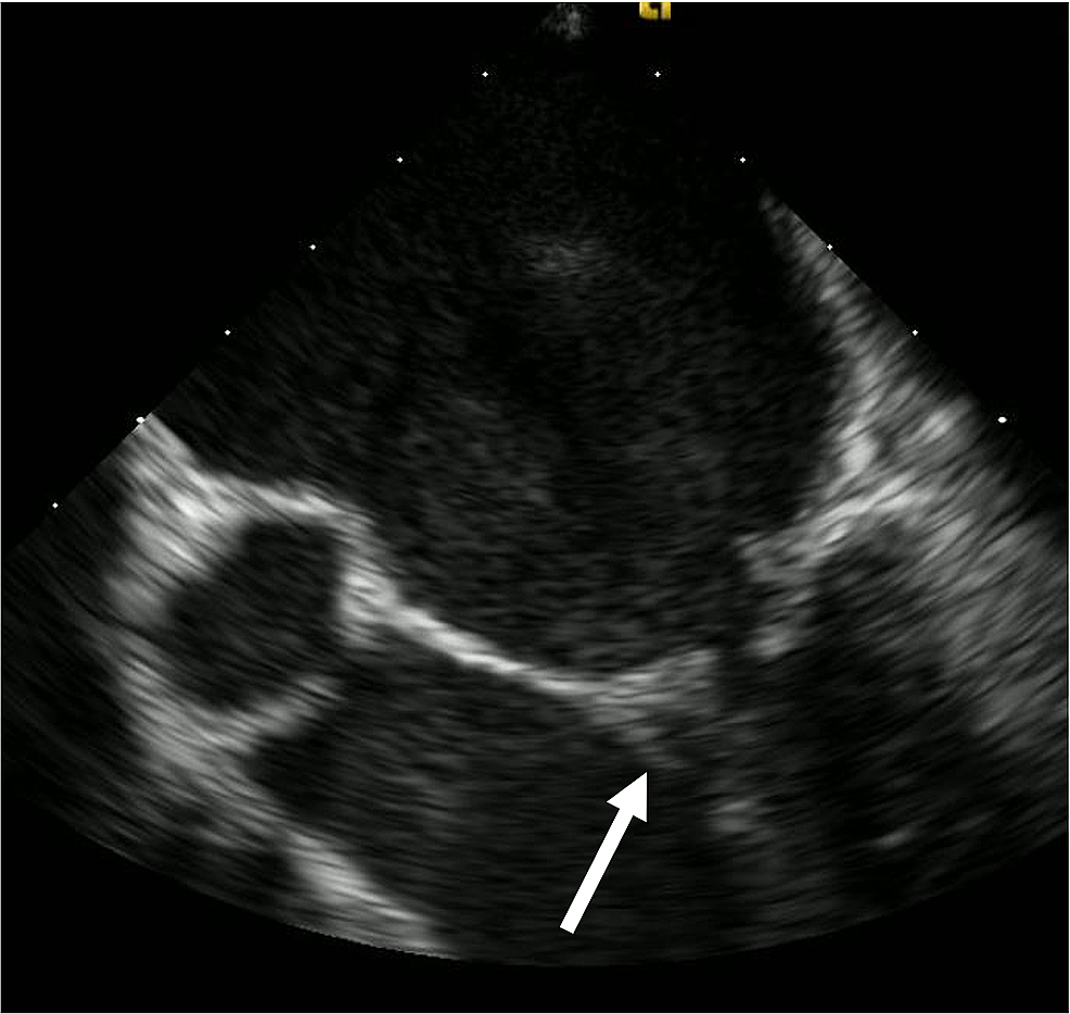 Transesophageal-echocardiogram-demonstrating-a-small-independently-mobile-linear-echo-density-on-the-posterior-leaflet-of-the-mitral-valve-(white-arrow),-consistent-with-a-vegetation.