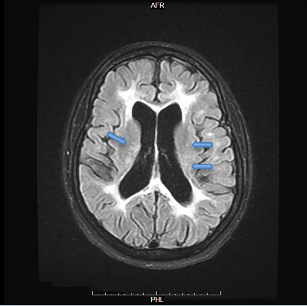 Neuropsychiatric Systemic Lupus Erythematosus With Early-Onset