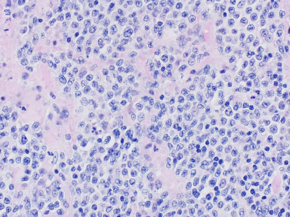 Cureus Diffuse Large BCell Lymphoma of the Left Upper