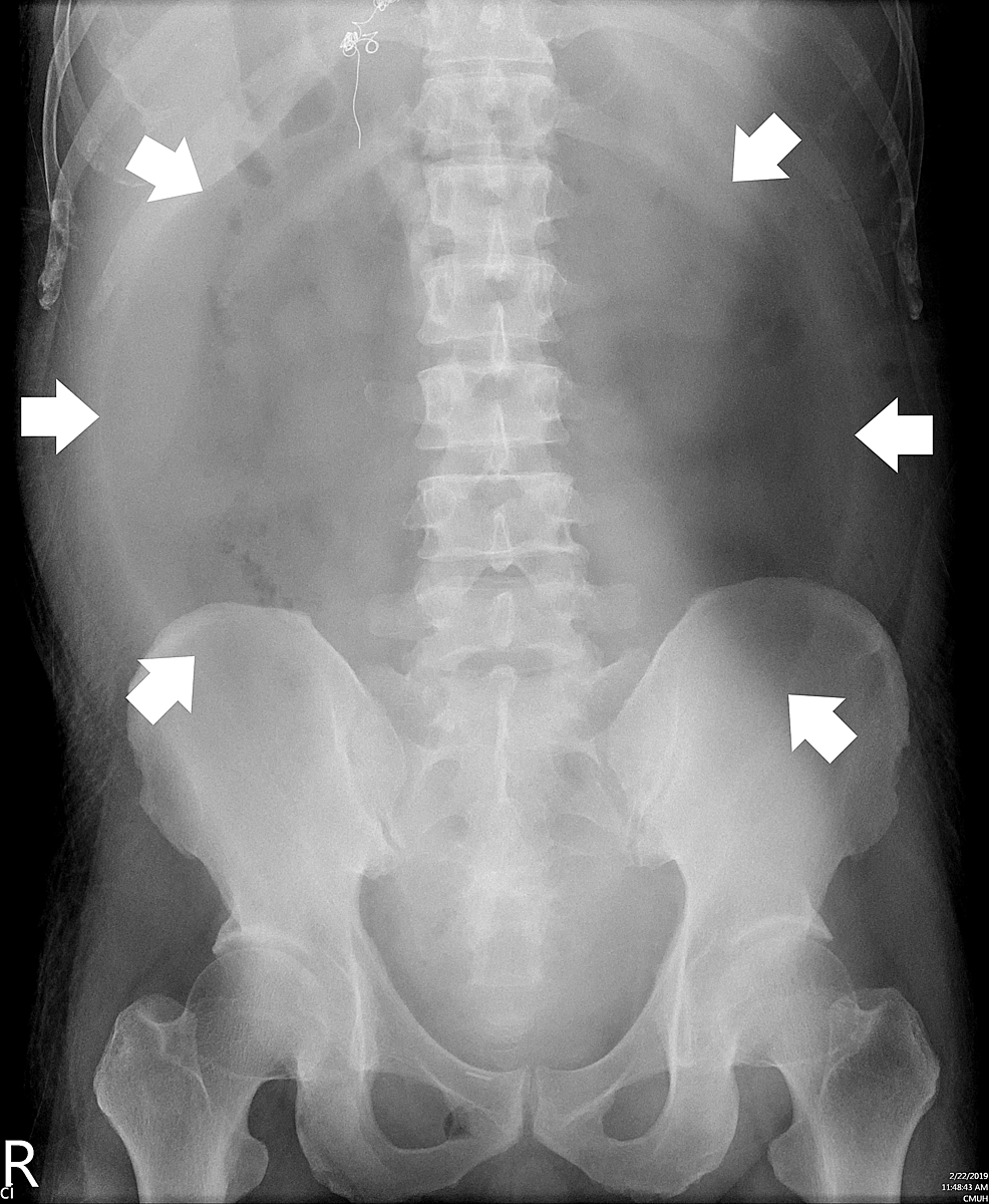 cureus-the-football-sign-an-alarming-feature-on-supine-radiograph