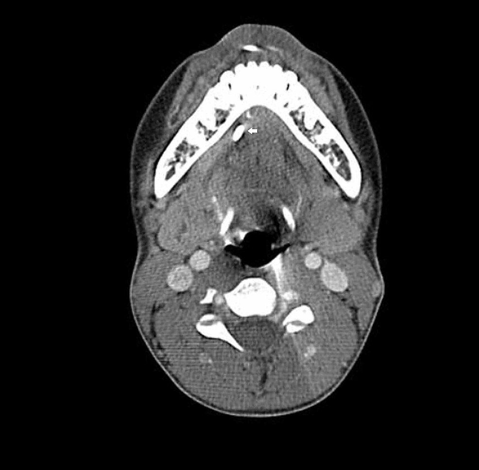CT-scan-of-the-neck-(axial-view)-with-a-stone-(white-arrow)--seen-in-the-Wharton's-duct