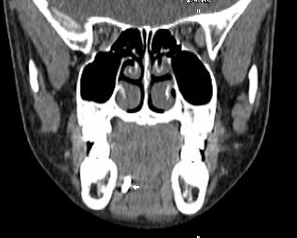 CT-scan-of-the-neck-(coronal-view)-with-a-stone-(white-arrow)-seen-in-the-Wharton's-duct