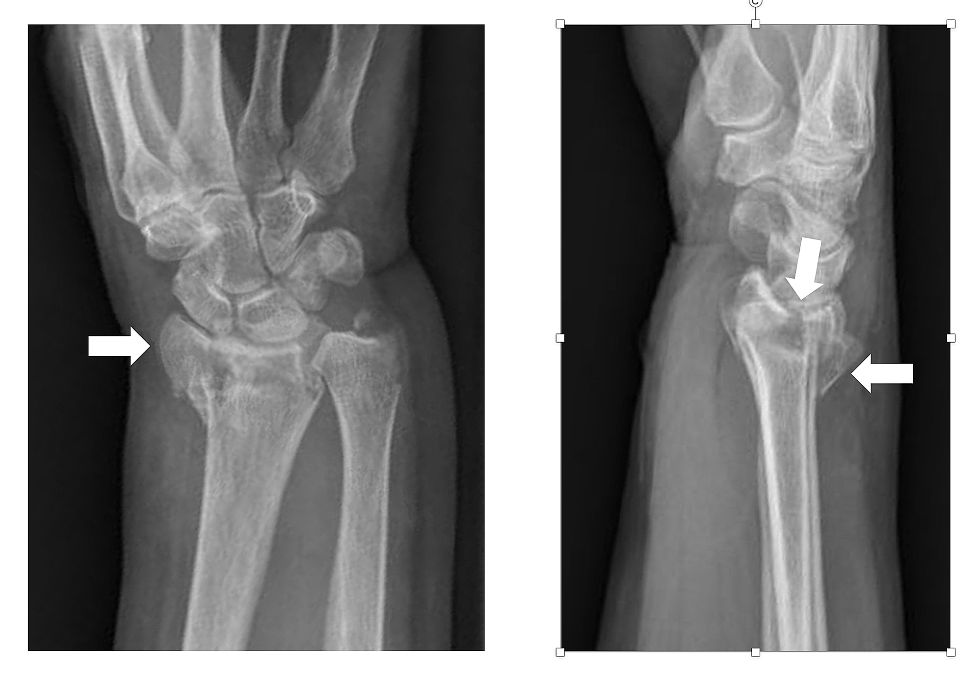 Cureus Use Of Surgical Adhesive Tape To Maintain Tension On Intrafocal K Wires For Easy Reduction And Fixation Of Complex Intra Articular Distal Radius Fractures