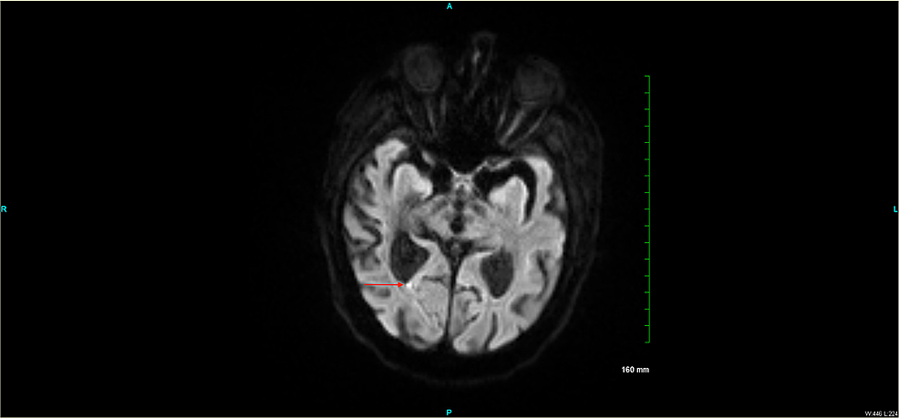 MR-axial-DWI-sequence-showing-focus-of-restricted-diffusion-in-the-right-splenial-region-of-the-corpus-callosum.-