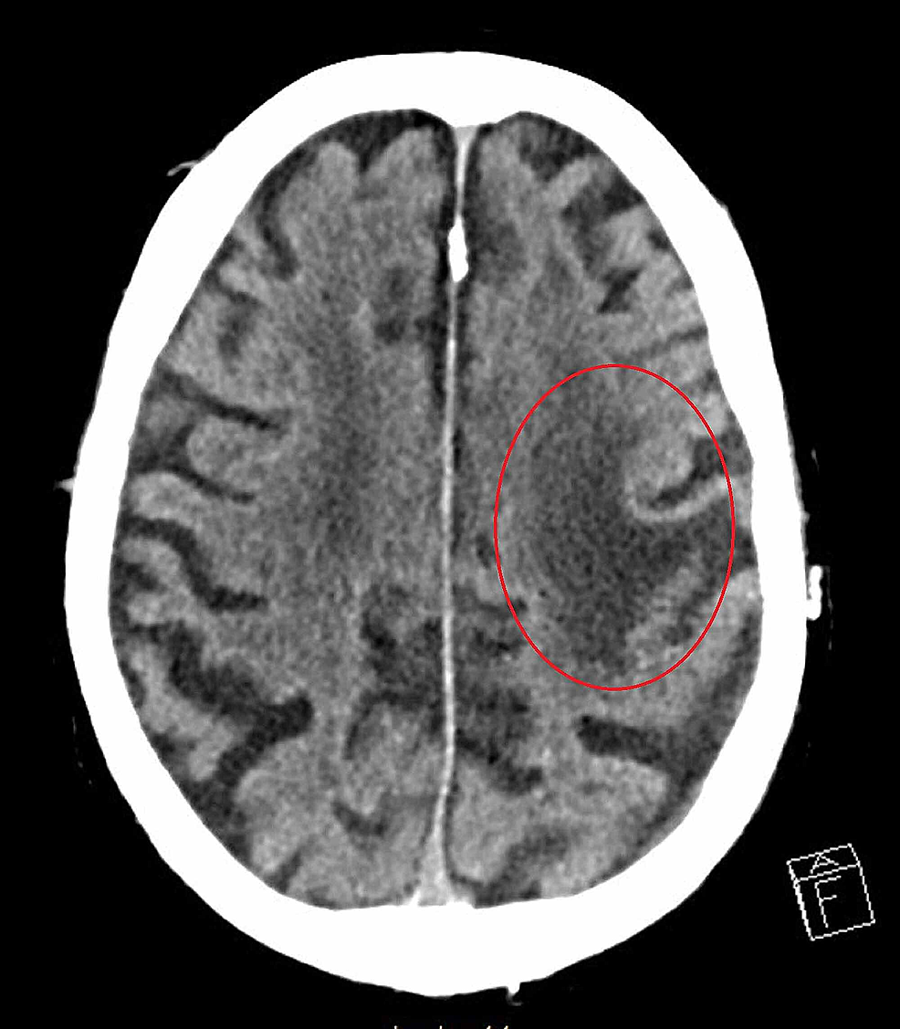 NCCT-scan-of-head-showing-hypodensity-in-left-frontal-lobe-representing-chronic-encephalomalacia.