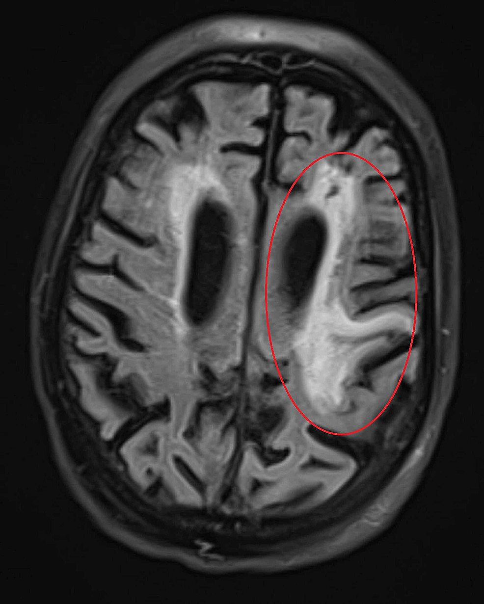 MR-axial-FLAIR-sequence-showing-increased-signal-in-left-frontal-lobe-representing-chronic-encephalomalacia.