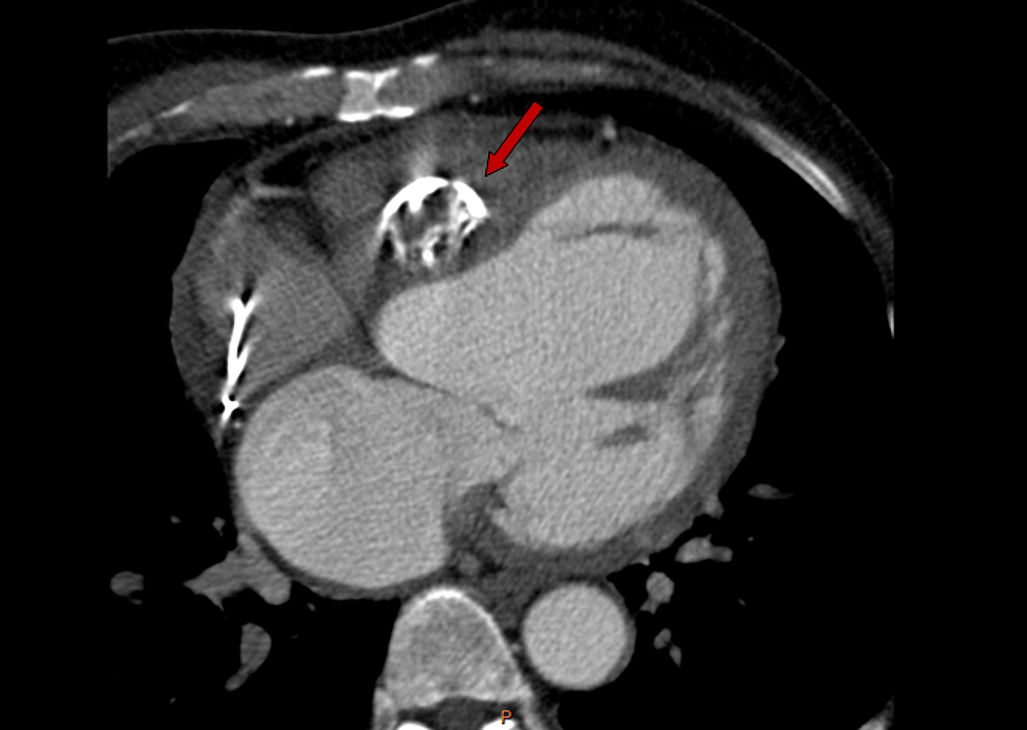 Cureus Isolated Cardiac Hydatid Cyst Causing Complete Heart Block