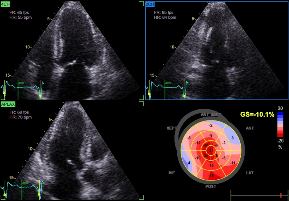 Transthoracic-echocardiography-demonstrating-reduced-global-longitudinal-strain-(-10%)-consistent-with-preserved-EF-(60%) Transthoracic-echocardiography-demonstrating-reduced-global-longitudinal-strain-(-10%)-consistent-with-preserved-EF-(60%)