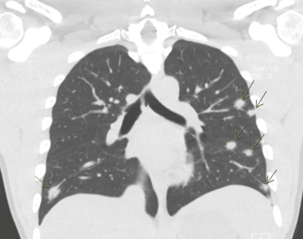 Atypical Presentation of Lemierre Syndrome Without an Oropharyngeal Source in a Young Adult Male Patient