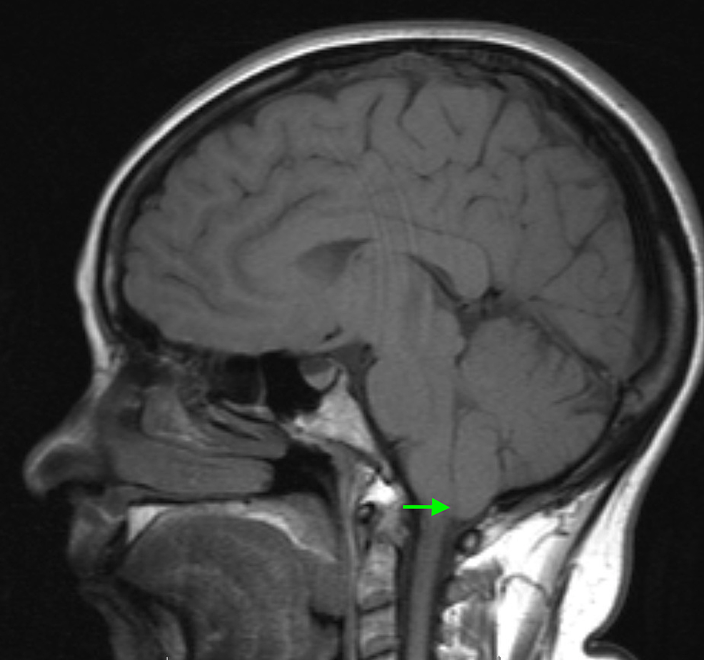 Delayed Cranial Nerve Palsies and Chiari Type I Malformation After ...