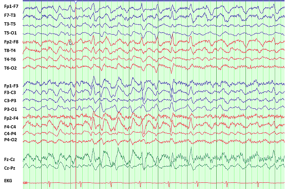 Eeg