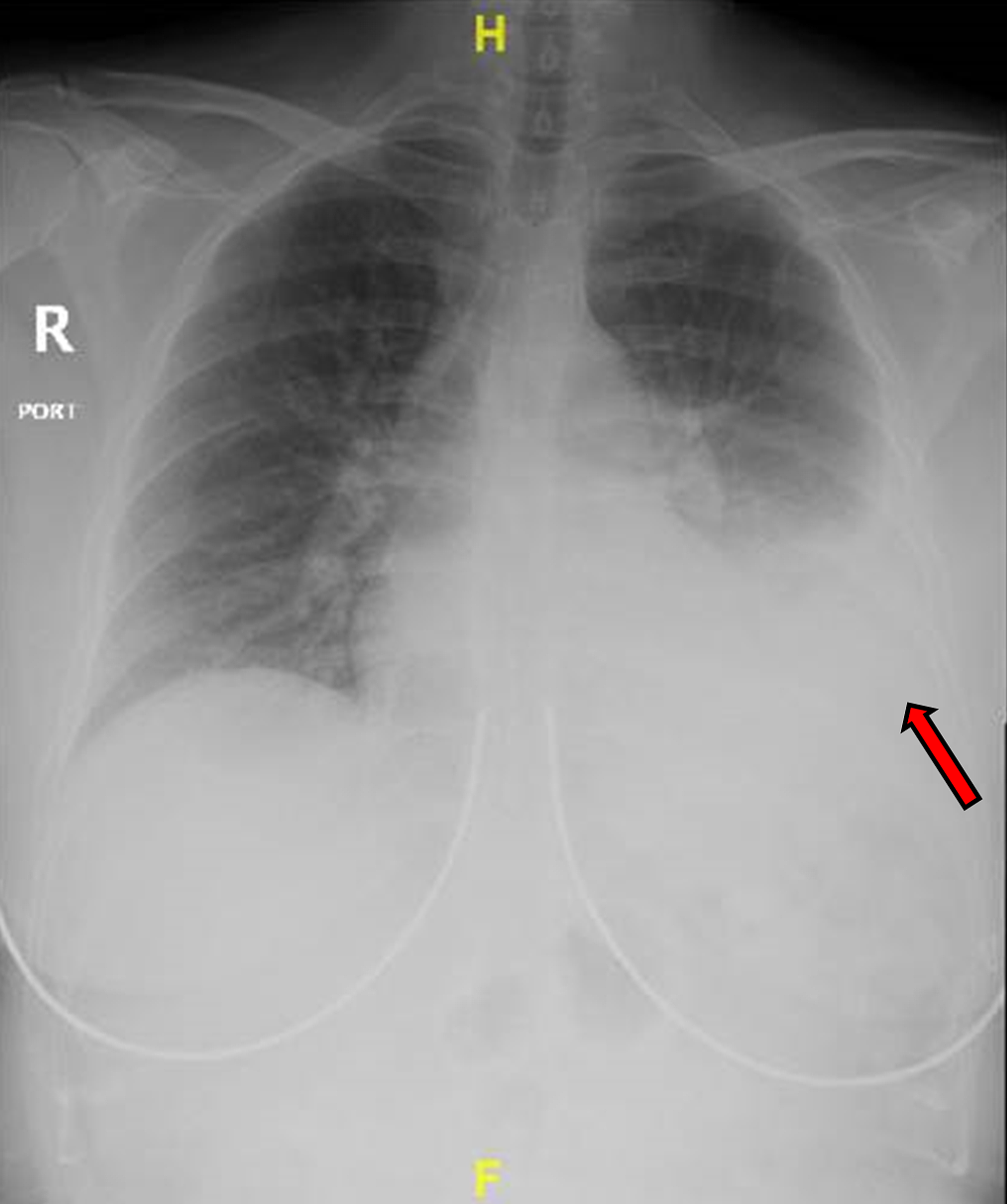 Cureus | Hemothorax After a Renal Biopsy With Ablation, a Rare ...