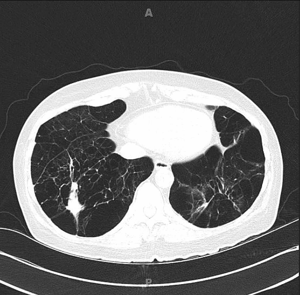 Cureus | A Case Of Alpha-1 Antitrypsin Deficiency And Organizing Pneumonia