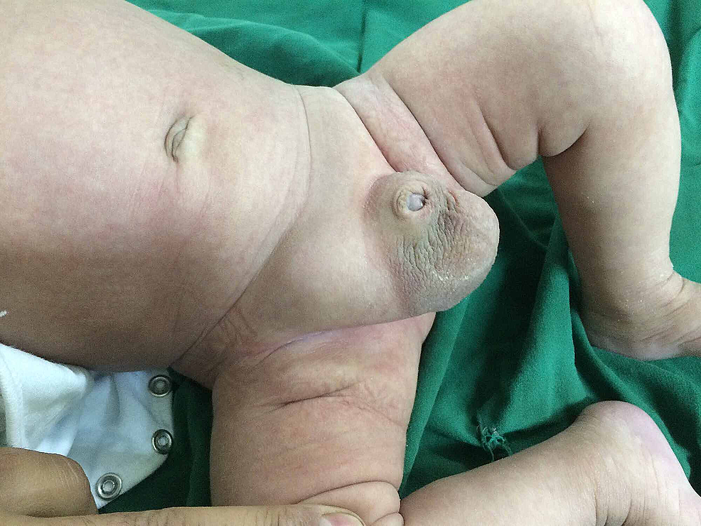 Congenital Inguinal Hernia