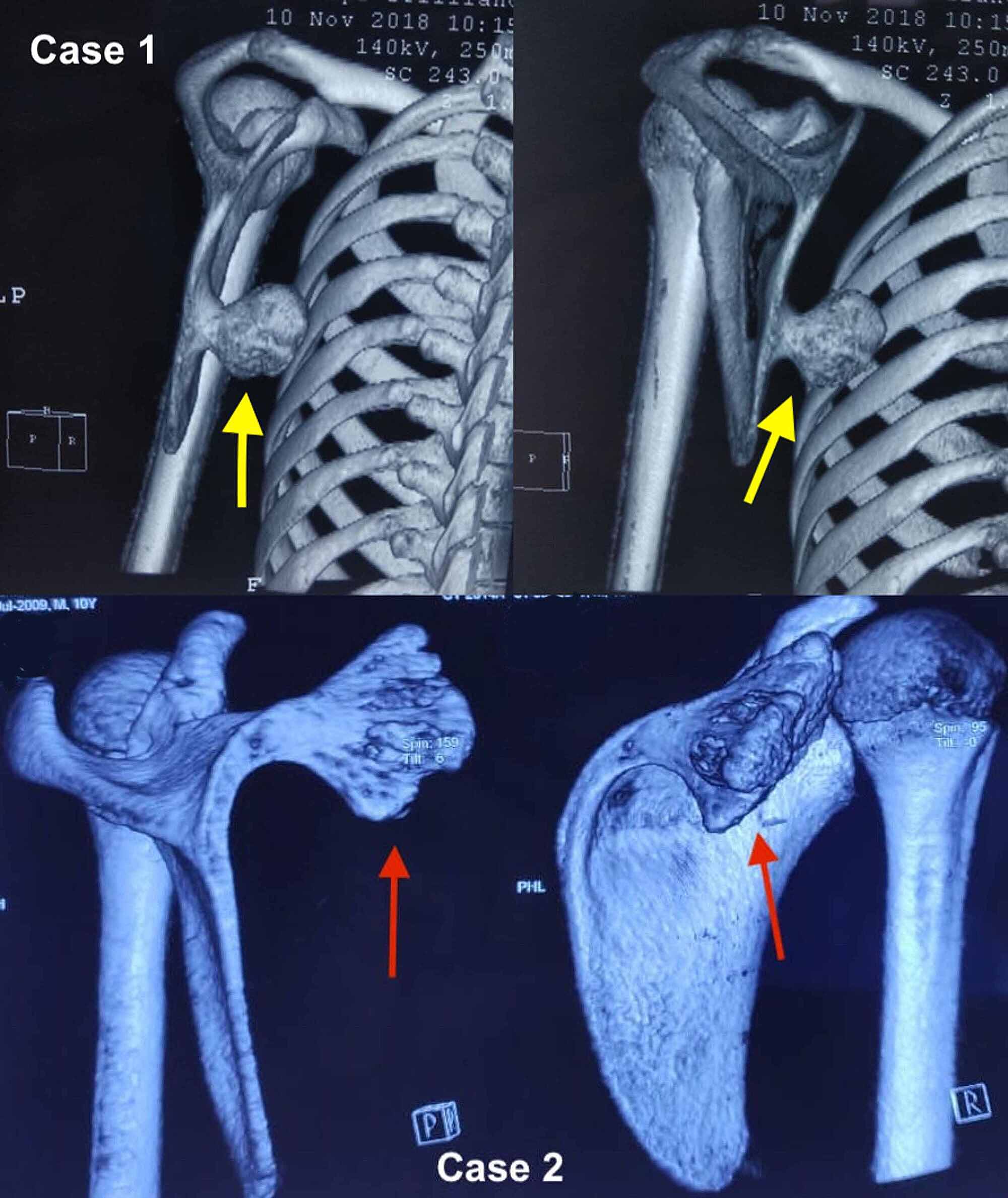 Cureus Winging of Scapula An Presentation of a Common Tumor