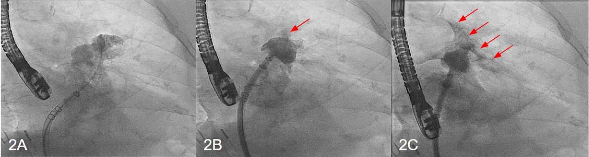 Cureus | Successful WATCHMAN Device Placement Despite Left Atrial