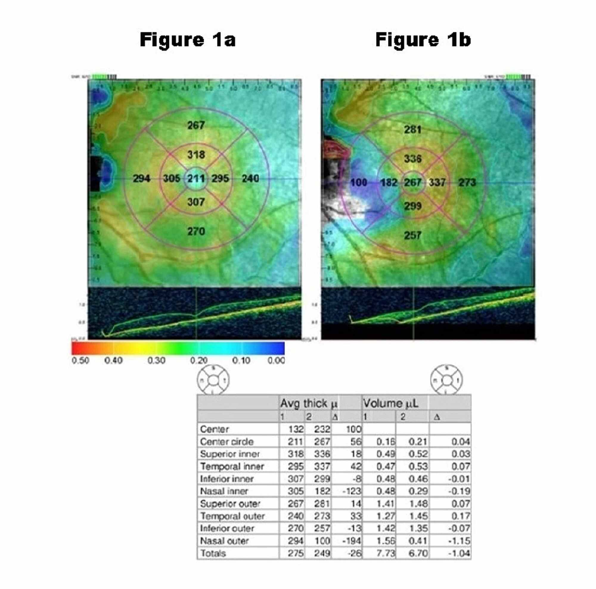 cureus-correlation-of-central-macular-thickness-and-the-best