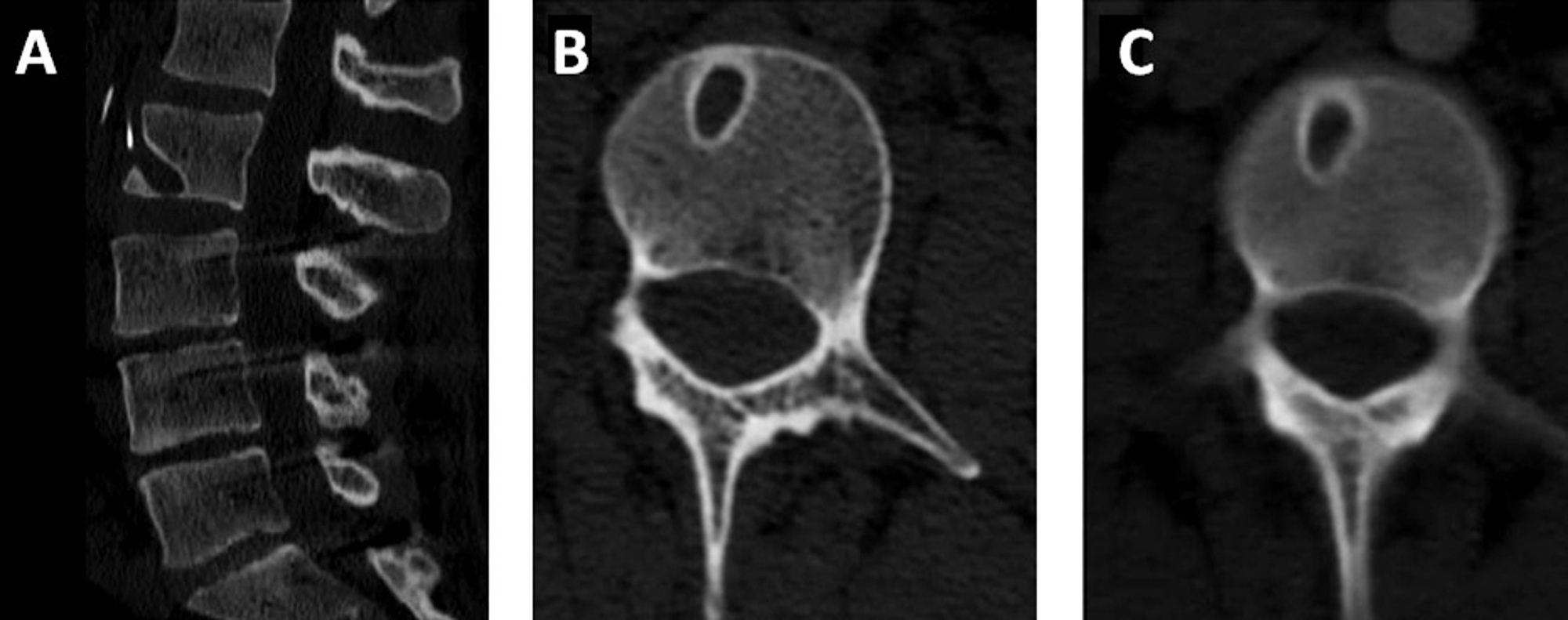 Cureus Vertebral Body Erosion and Subsequent Back Pain Secondary to a