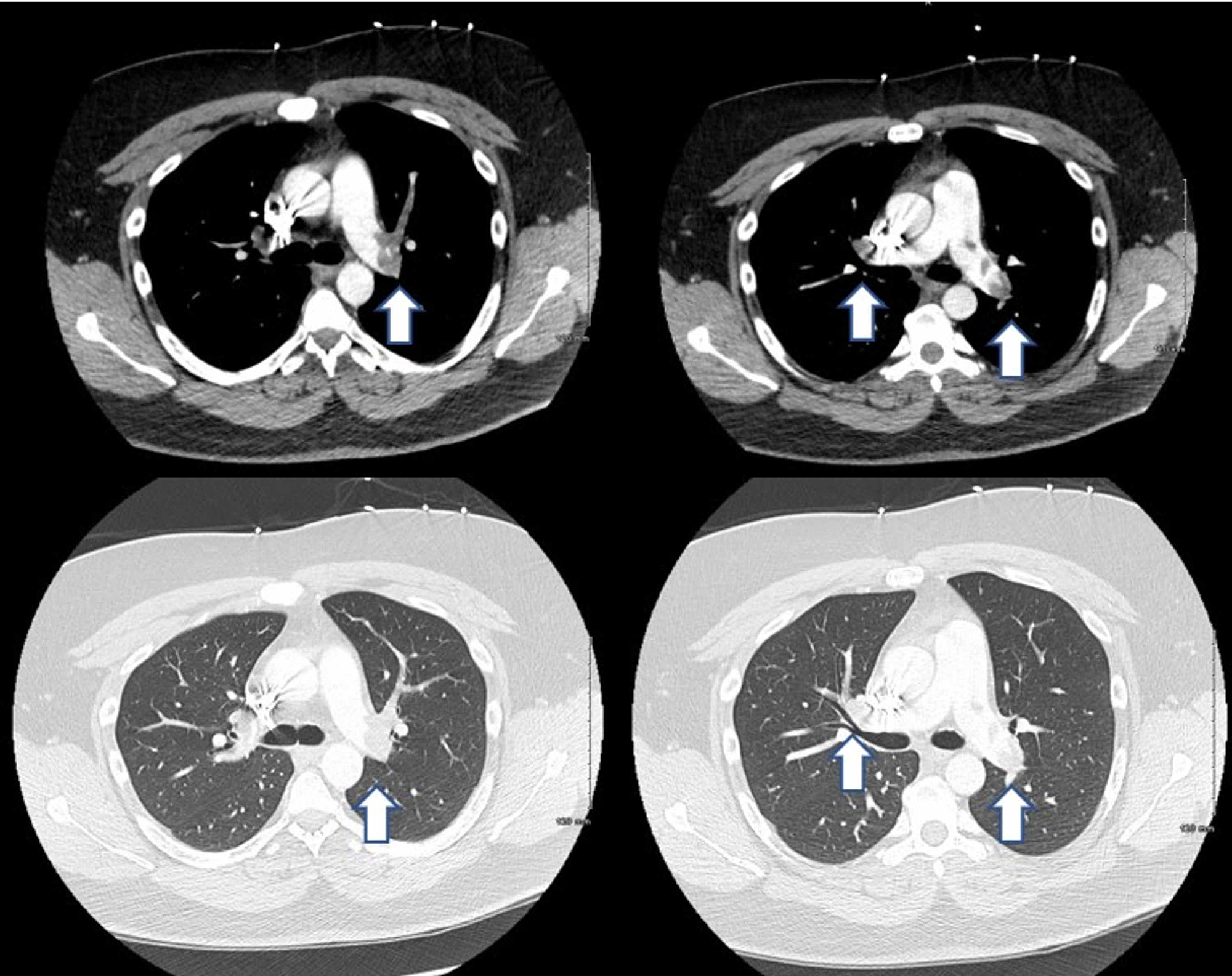 Cureus UltrasoundFacilitated CatheterDirected Thrombolysis via Dual