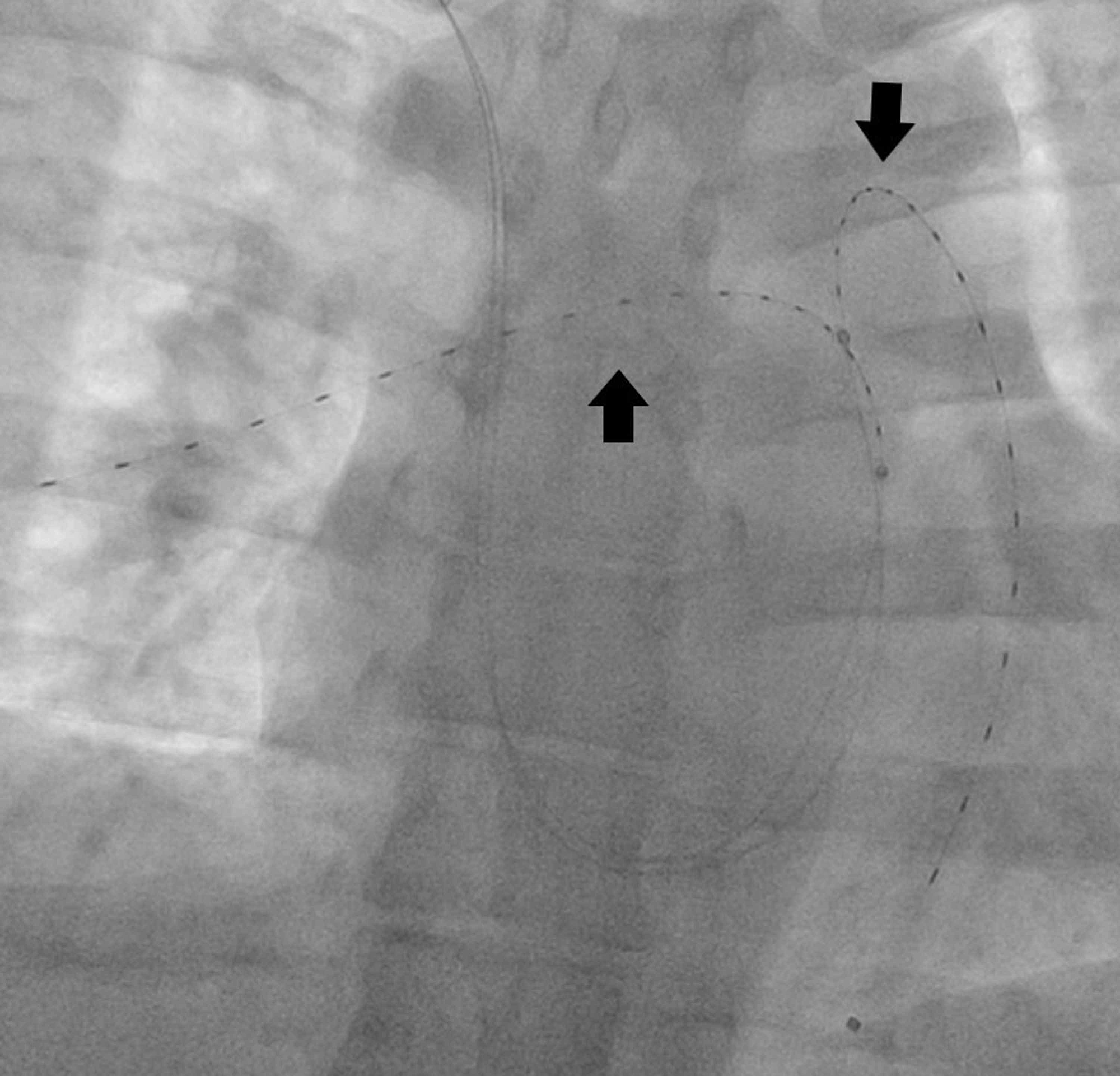 Cureus UltrasoundFacilitated CatheterDirected Thrombolysis via Dual
