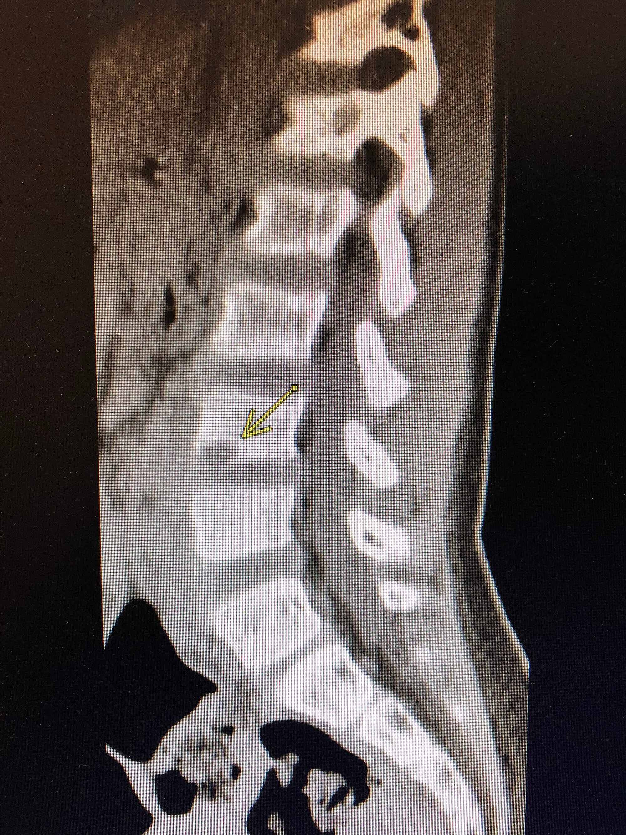 Cureus | A Case of Osteodiscitis in a Preschool-Aged Child