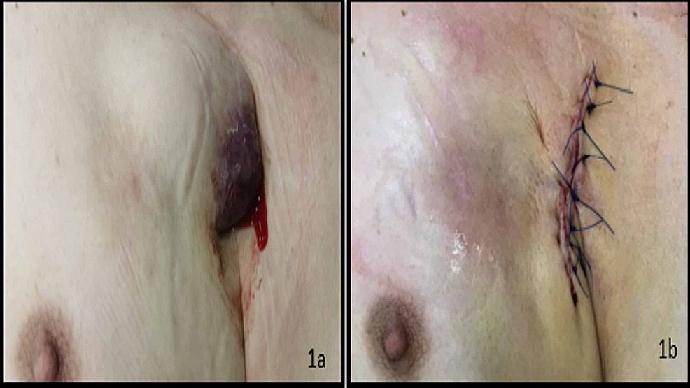 Erythema on the chest after attachment of suction-cup based-precordial