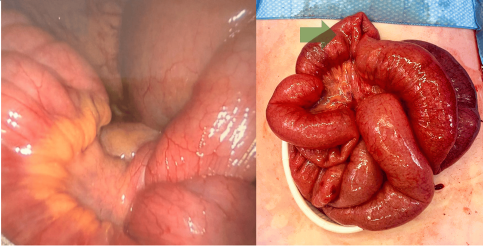 A Rare Presentation of Small Bowel Volvulus Secondary to Meckel’s Diverticulum-Induced Intussusception in an Adolescent Female