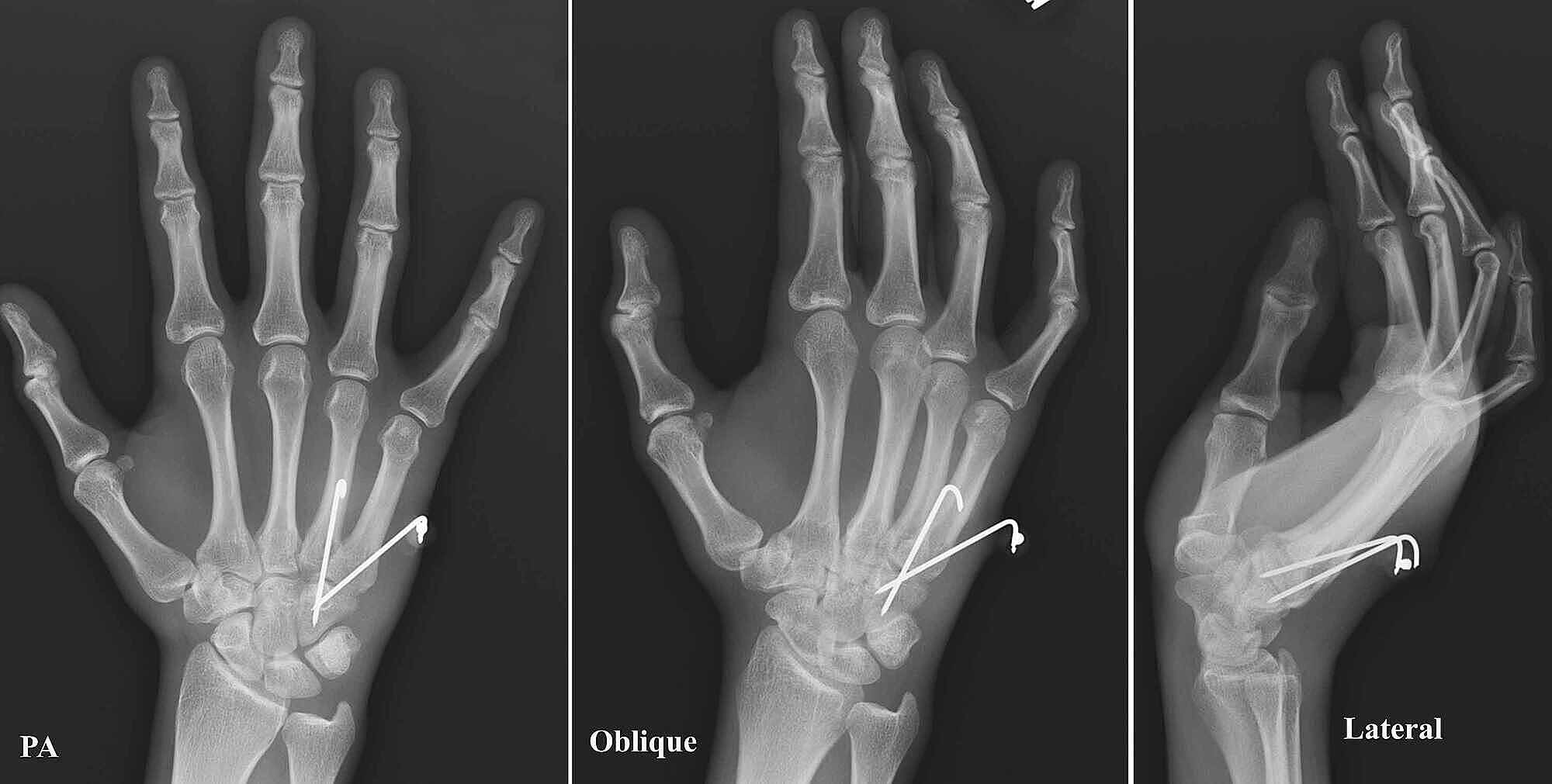 Cureus Isolated Dorsal Dislocations of the Fourth and Fifth