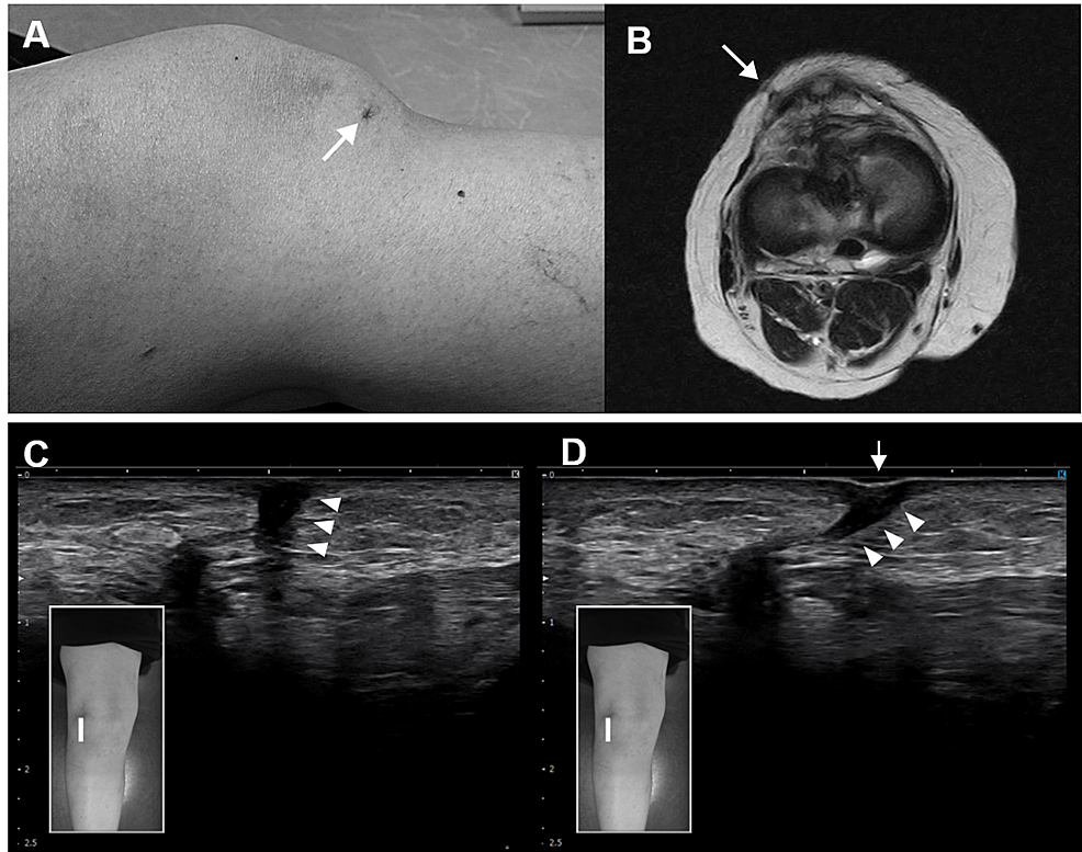 A New Procedure for UltrasoundGuided Hydrorelease for the Scarring