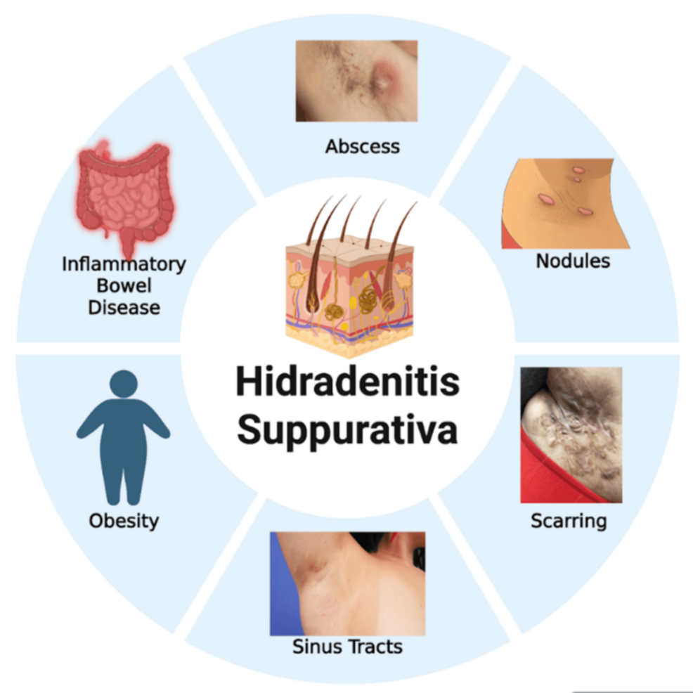 Tumor Necrosis Factor (TNF)-Alpha Inhibitors in Hidradenitis Suppurativa: A Systematic Review of Inflammatory Markers and Alternative Monitoring Strategies