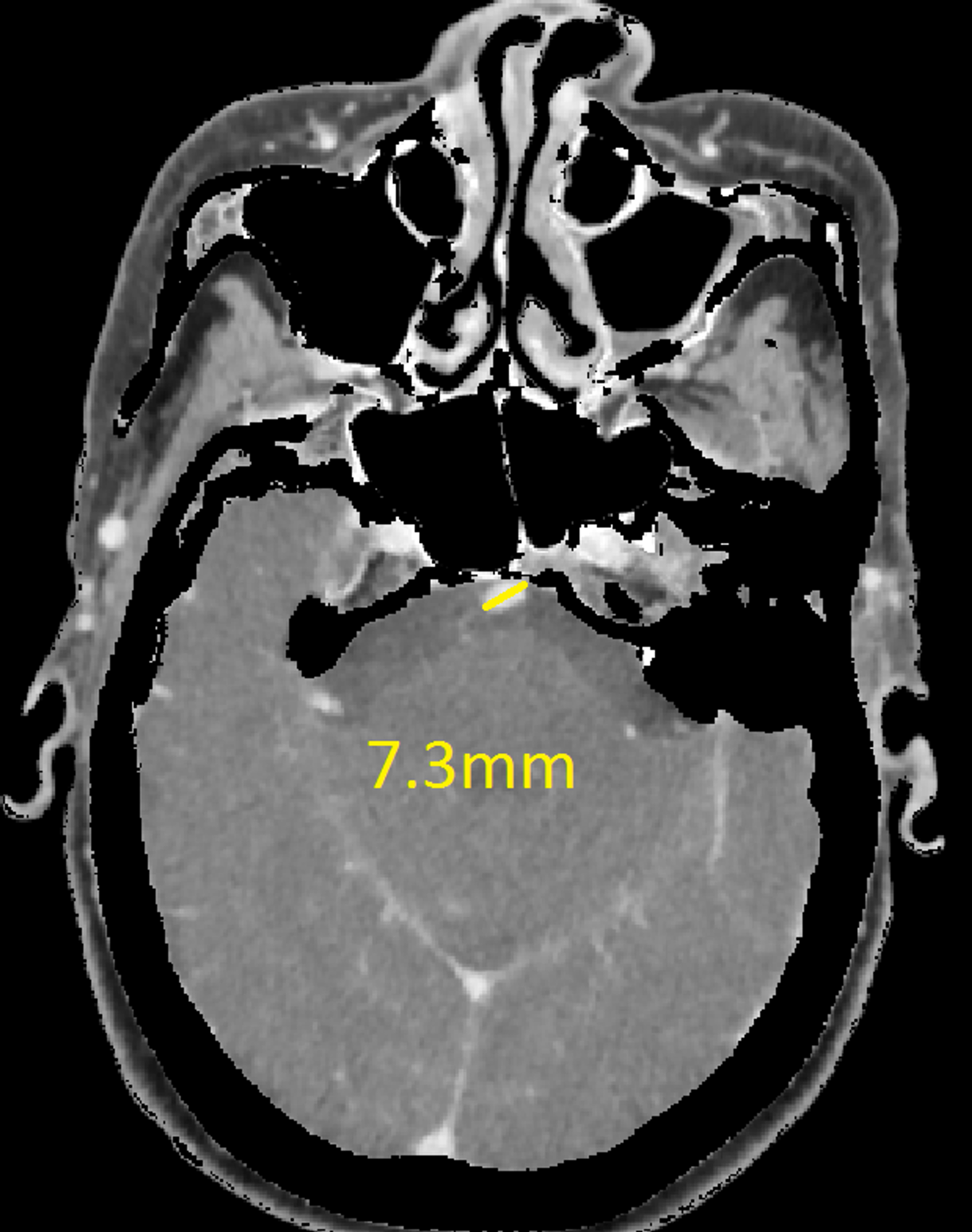 Cureus Dolichoectasia And Its Diagnostic Criteria A Case Report And Literature Review