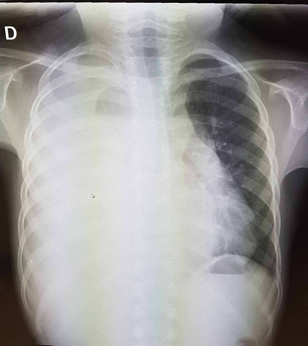 Cureus | Primary Rhabdomyosarcoma of the Pleura: A Case Report and