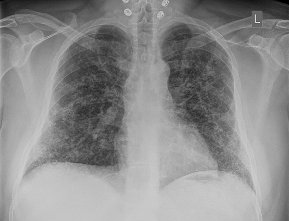 Cureus | First Case of Dendriform Pulmonary Ossification in Bahrain