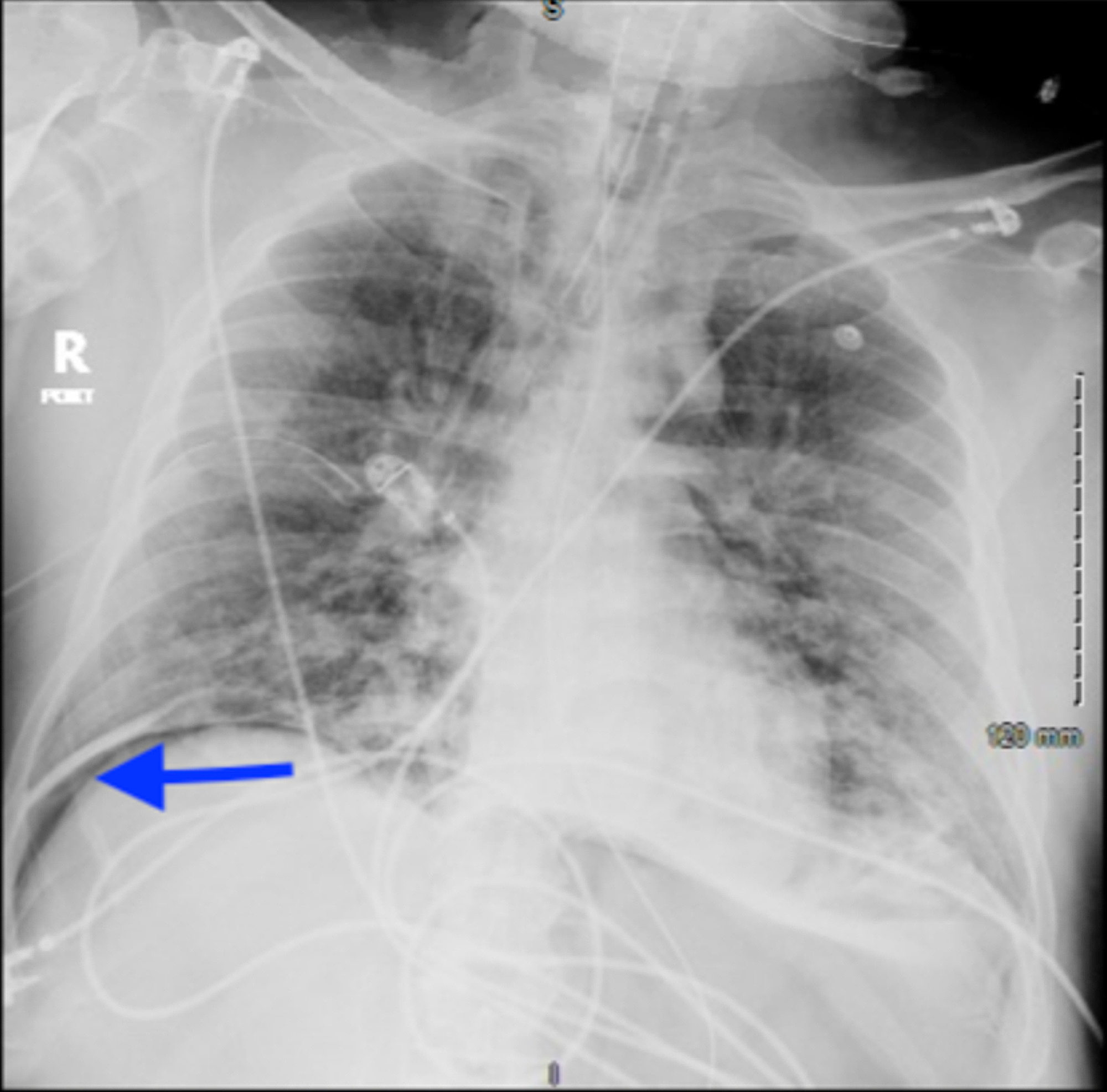 Cureus An Intriguing Case Of Pneumoperitoneum In A Patient With Covid