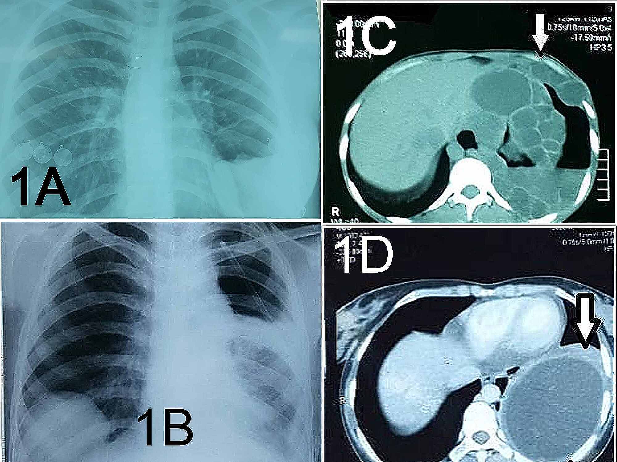 Cureus | Management Outcome in Simple and Complex Hydatid Cysts of Lung