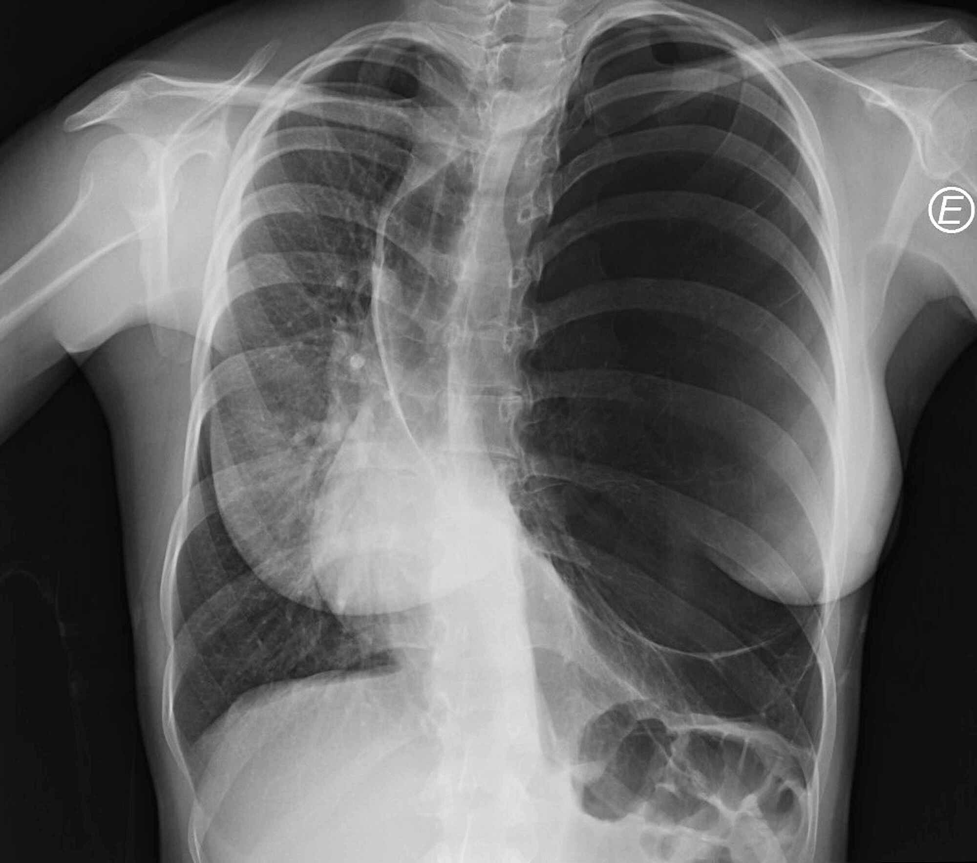 Cureus Congenital Lobar Emphysema in Early Adulthood