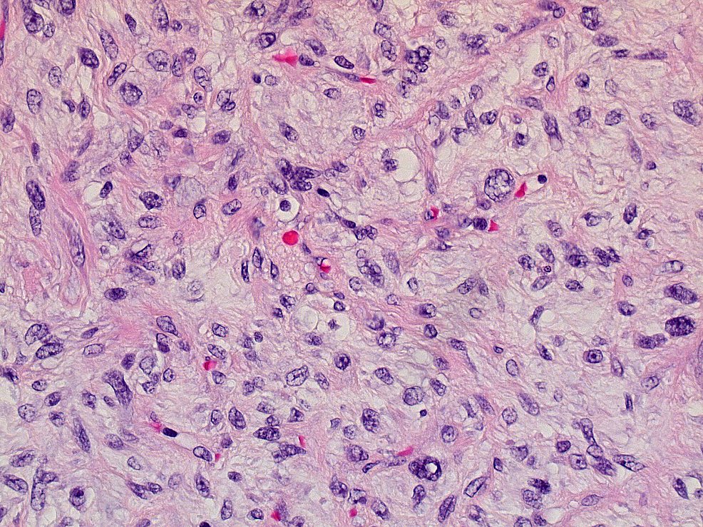 Cureus | Retroperitoneal Liposarcoma Presenting With Malignant Gastric ...