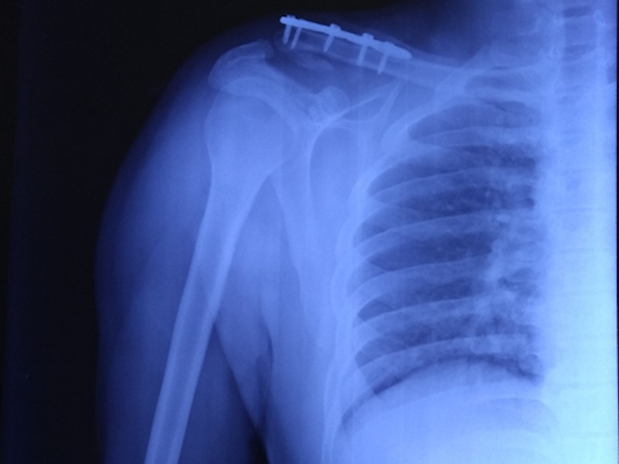 Cureus Clinical Outcome Of Neer Type Ii Lateral End Clavicle Fractures With Coracoclavicular Ligament Disruption Treated With Pre Contoured Locking Plate And Endobutton