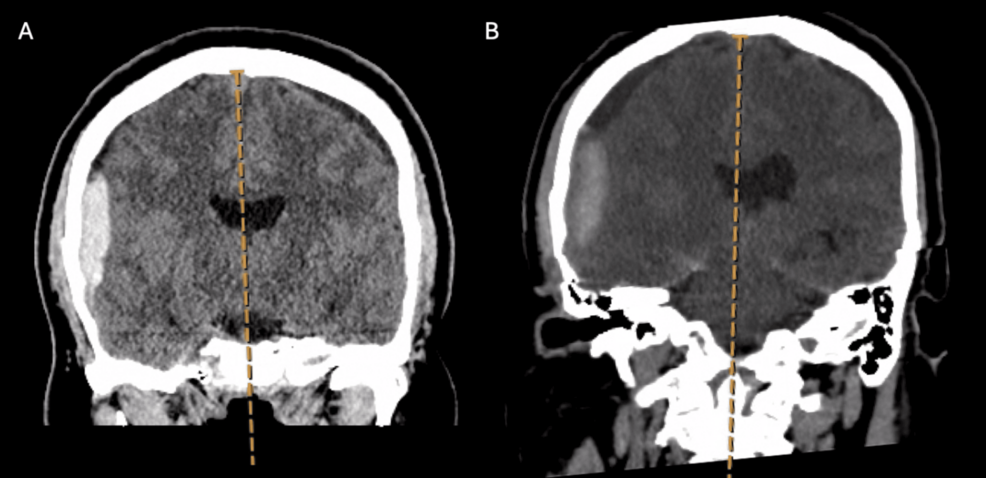 Spontaneous Intracranial Hypotension Presenting as Cryptogenic Coma: A Case Report and Literature Review Emphasizing the Role of Advanced Myelography