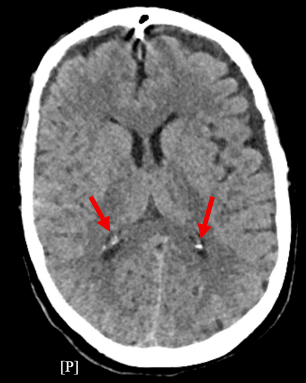 Seizure Prophylaxis After Intracerebral Hemorrhage in a Patient With Psychiatric Illness: A Case Report