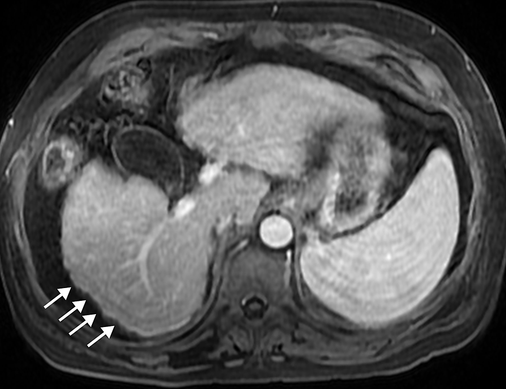 Cureus Magnetic Resonance Imaging Of Primary Hepatic Malignancies In Patients With And Without