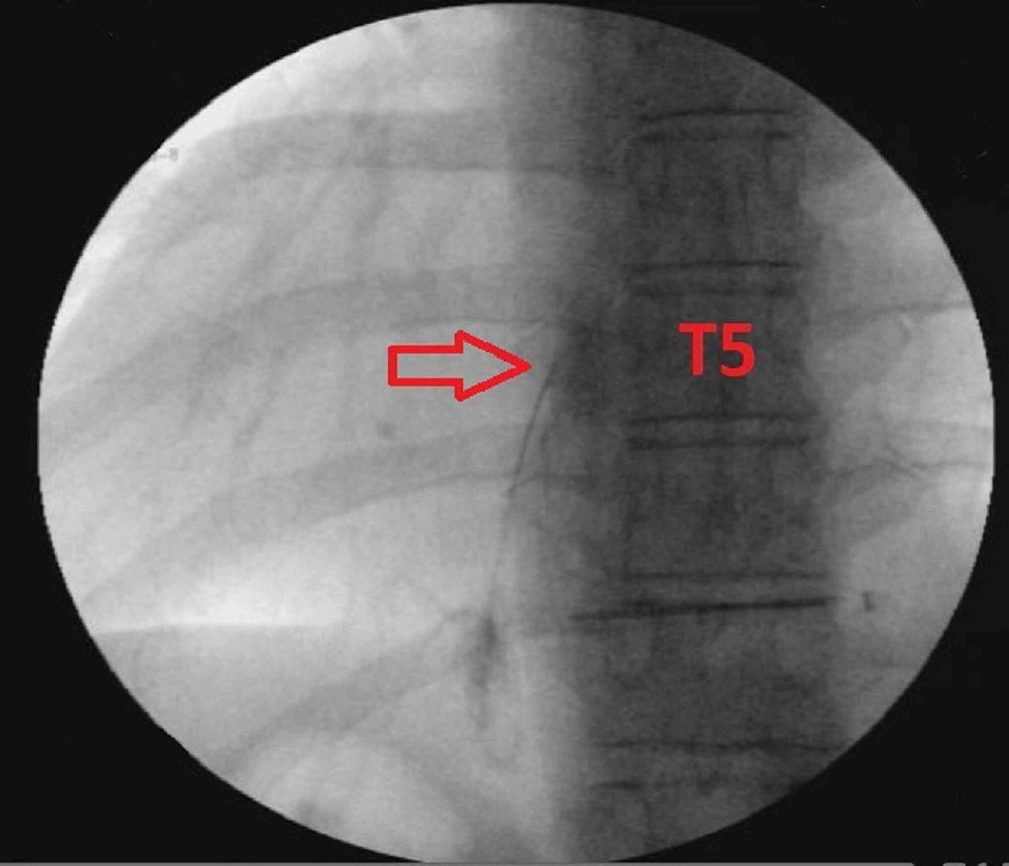 Cureus Erector Spinae Plane Block For The Treatment Of Post