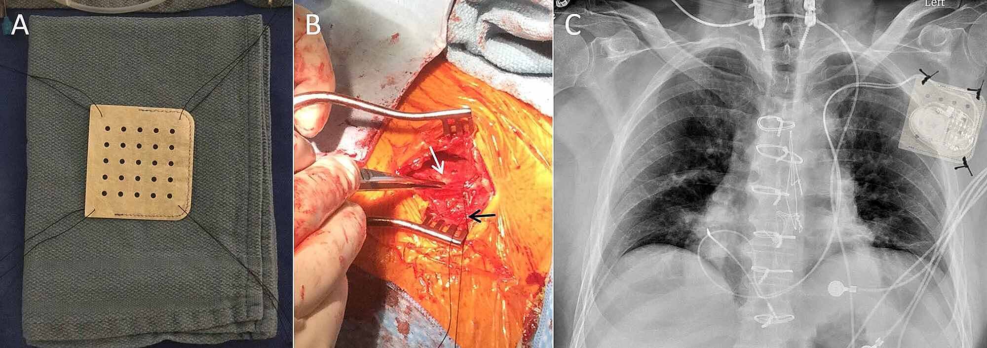 Cureus Pacemaker Pocket Stabilization Utilizing a Novel Envelope and