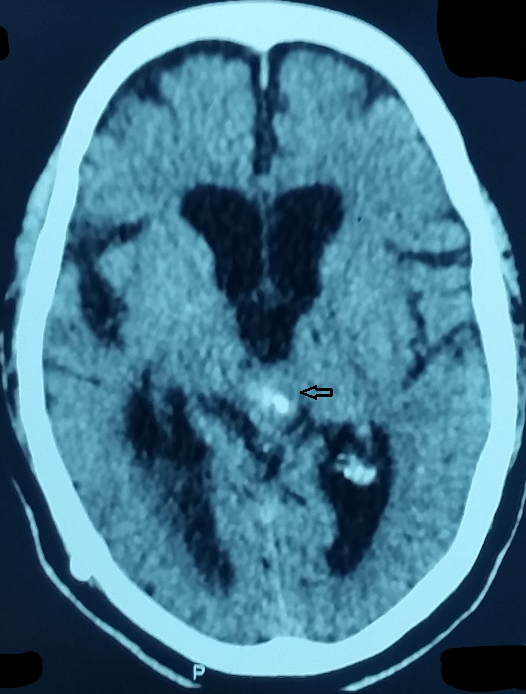 Cureus Pineal Gland Tumor But Not Pinealoma A Case Report 0775