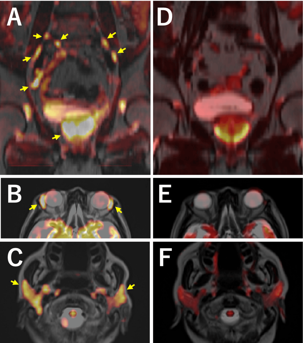 IgG4 Prostatitis: DWIBS Imaging for Detection