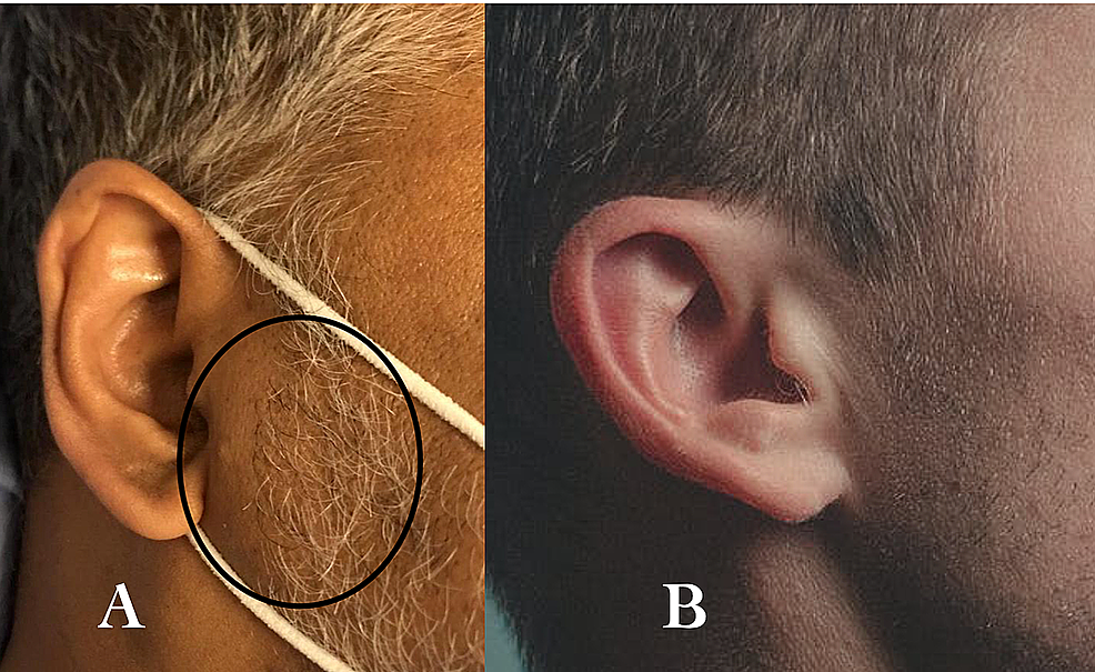 -(A)-The-reported-case-with-circled-sideburn-obesity--(B)-Normal-sideburn-area-