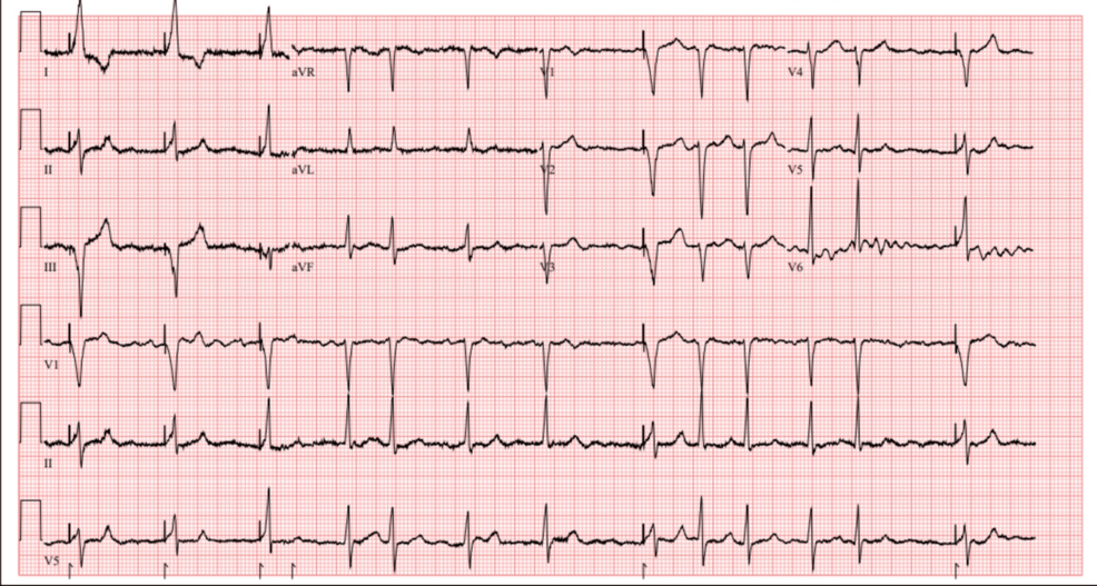 COVID-19-Induced Left Atrial Appendage Thrombus