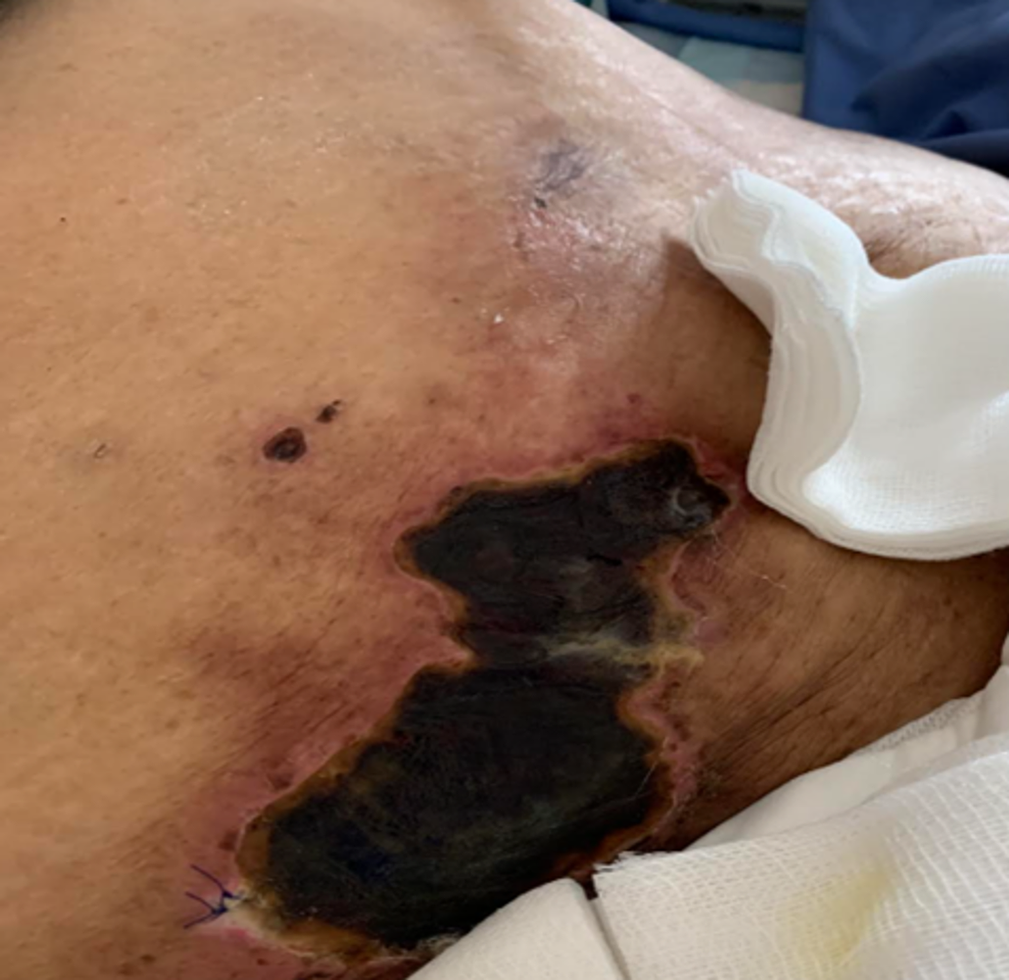 skin calciphylaxis