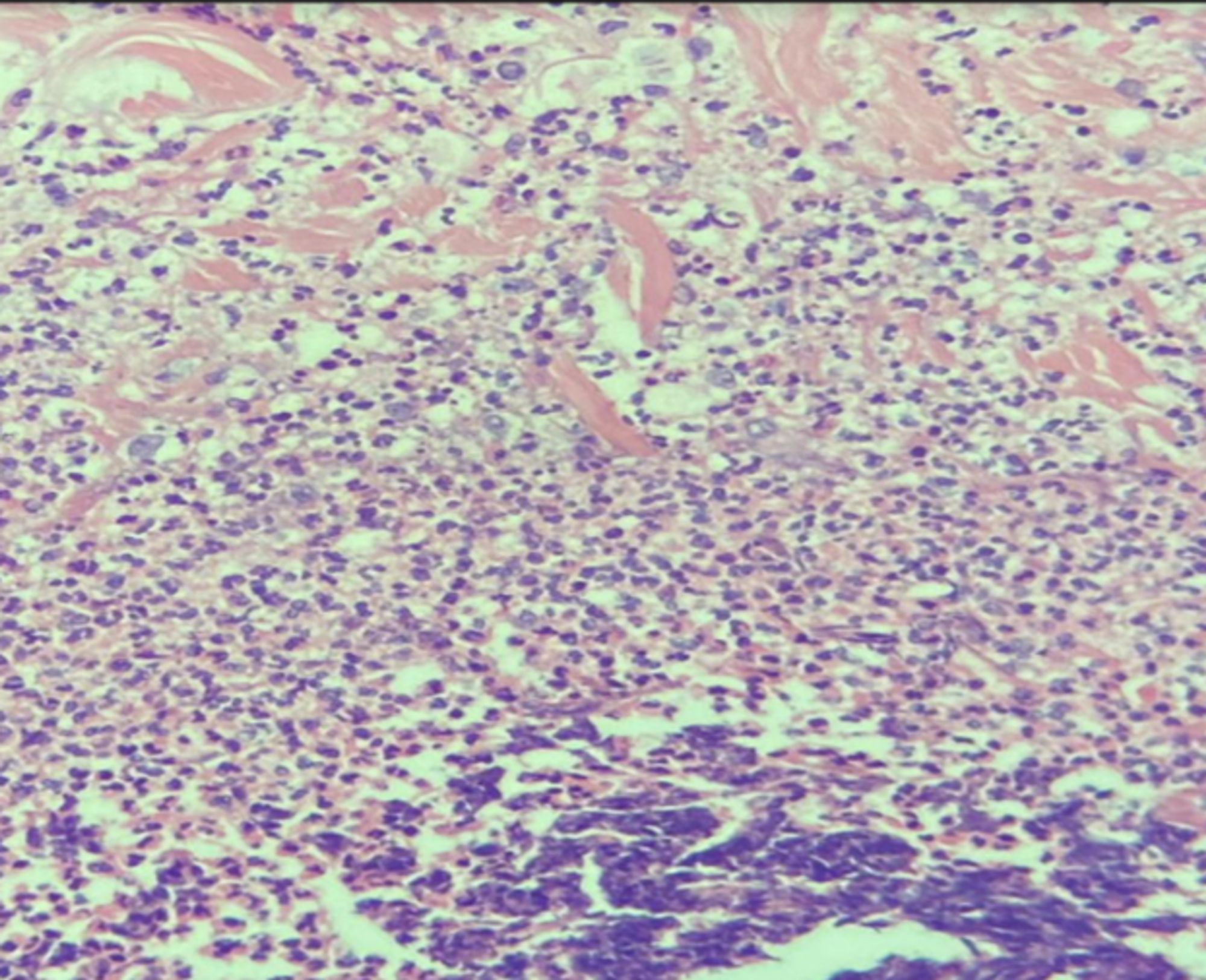 warfarin induced calciphylaxis