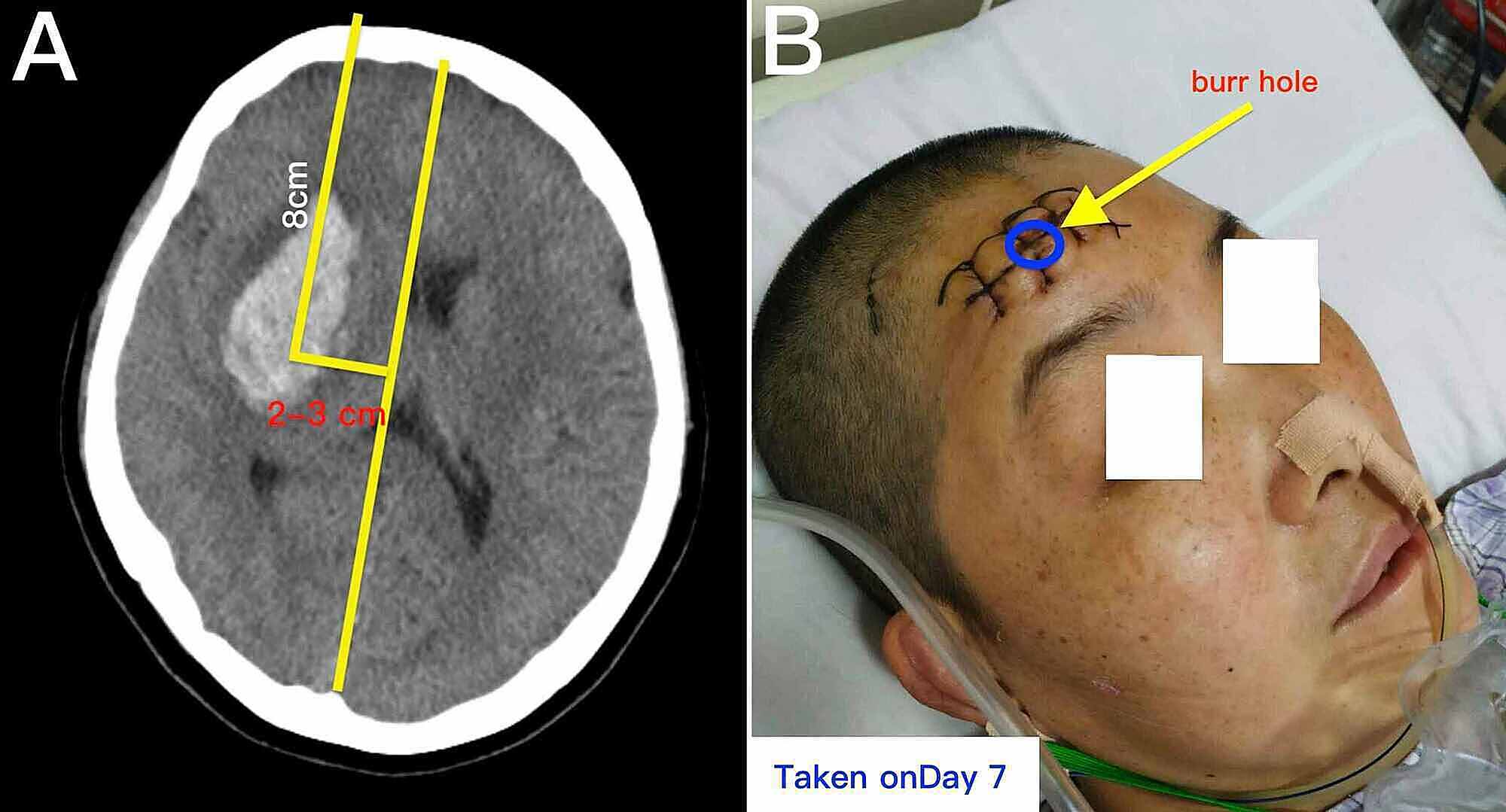 Cureus Massage of a Hematoma to Assist in Decreasing the Volume of an